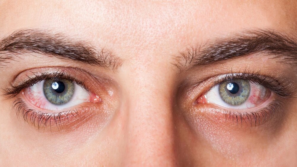 چطور از خشکی چشم جلوگیری کنیم؟