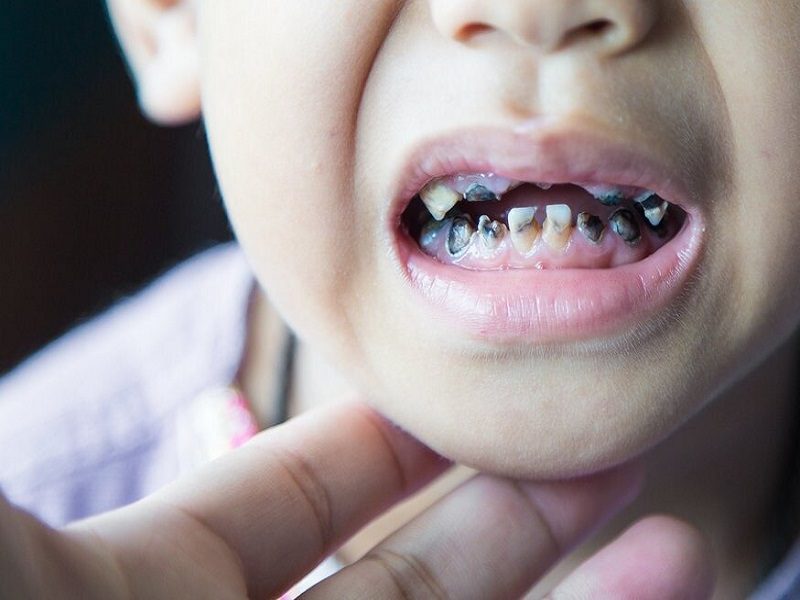 بهترین روش مراقبت از دندان های کودکان کم توان و ناتوان