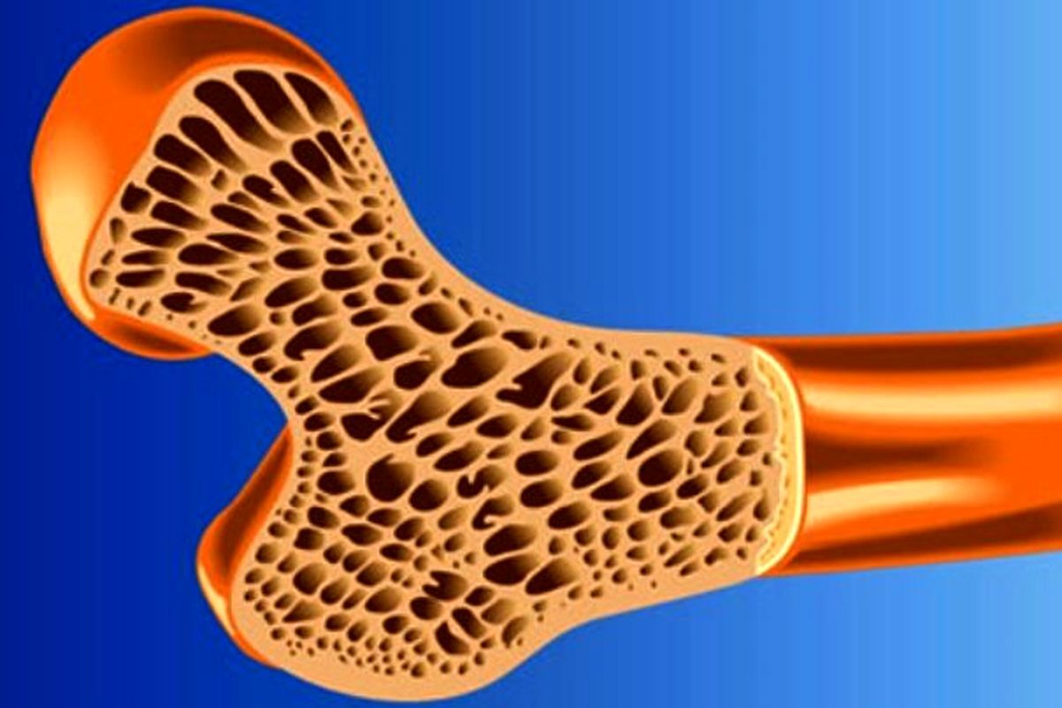 این گروه پوکی استخوان را جدی بگیرند