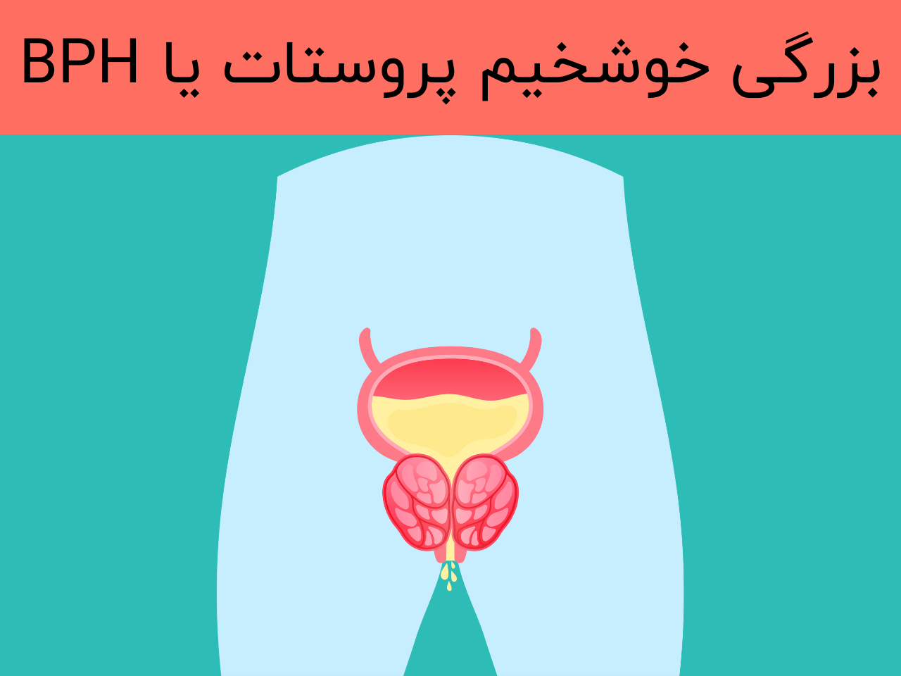 بزرگی خوشخیم پروستات یا BPH