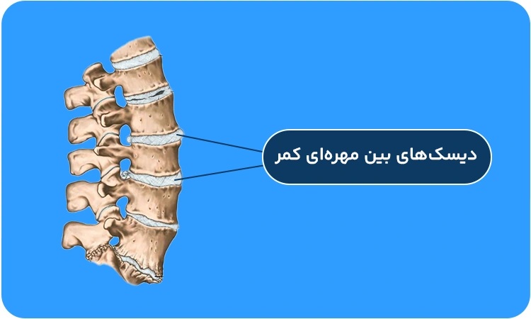 تصویری از ستون فقرات و محل قرارگیری دیسک‌های بین مهره‌ای کمر.