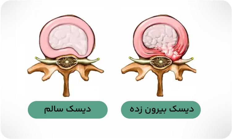 تصویری از دیسک بیرون زده در مقایسه با دیسک کمر سالم و بدون نقص.