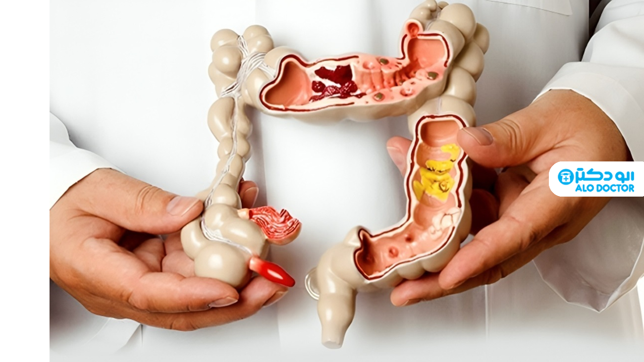 علل، علائم و درمان سندرم روده تحریک‌پذیر (IBS)