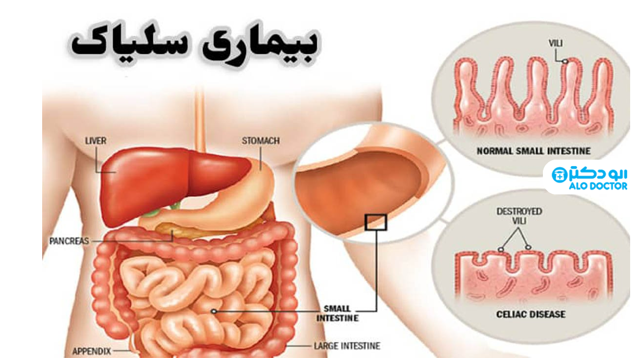 علائم و تشخیص بیماری سلیاک