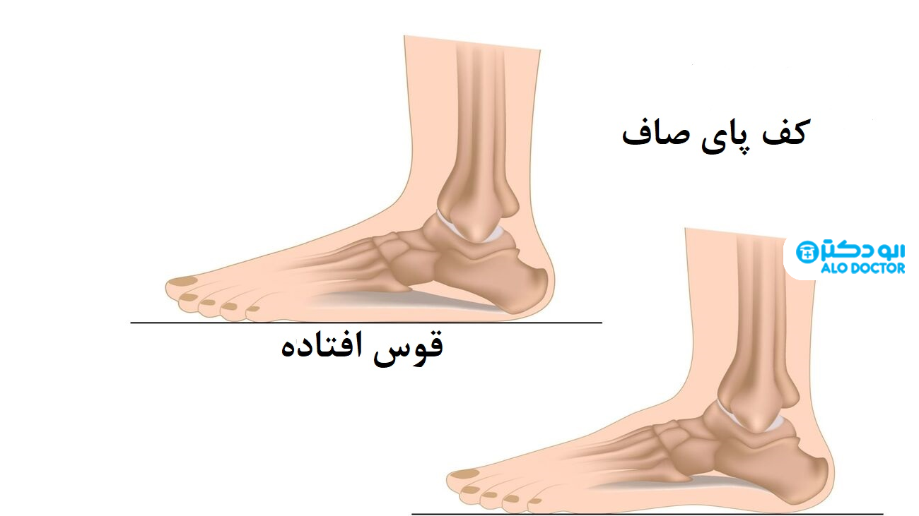 ساختار، اهمیت، اختلالات و درمانی قوس‌های کف پا