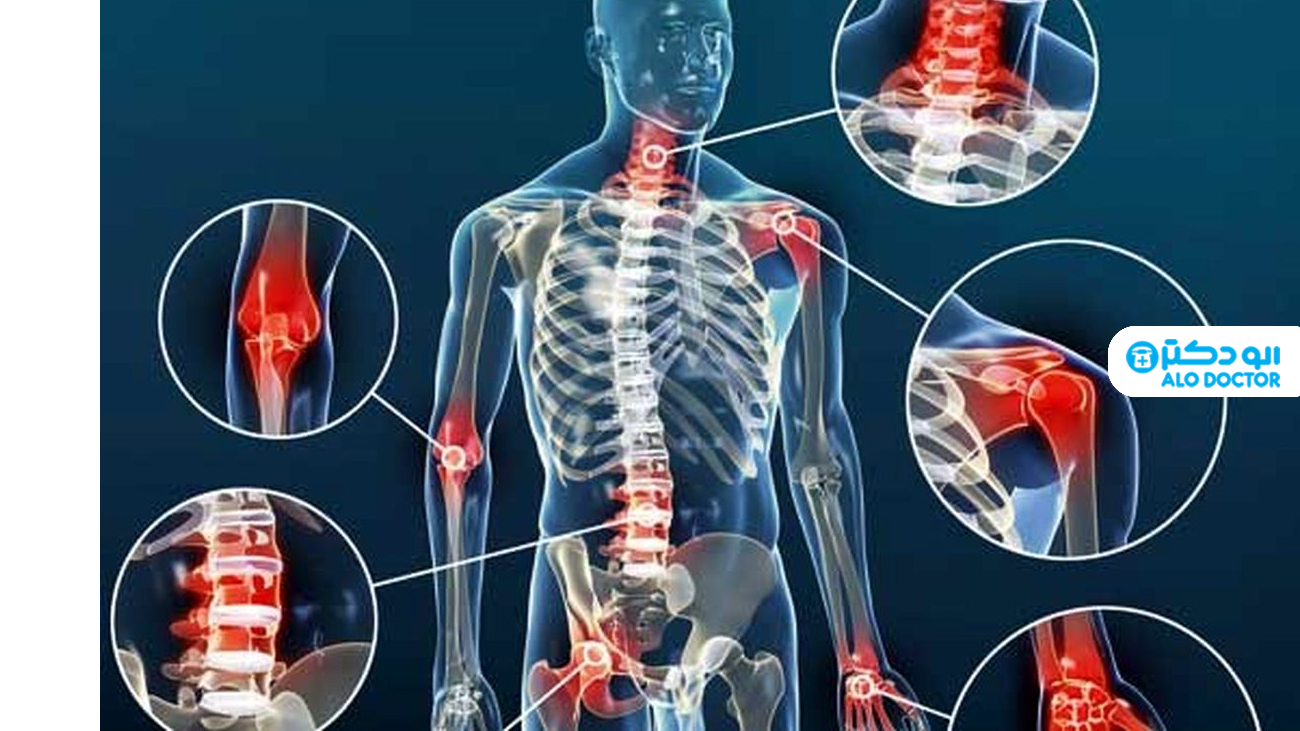 علل، نشانه‌ها، تشخیص، درمان و پیشگیری آرتروز و مشکلات مفصلی